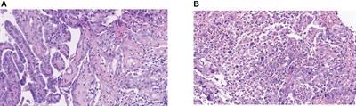 Radiotherapy combined with immunotherapy successfully treated one case of anaplastic thyroid cancer: A case report